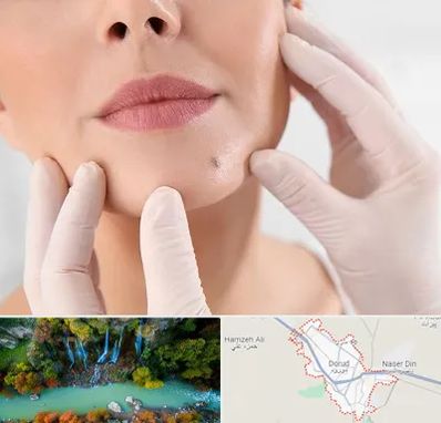 برداشتن خال در دورود