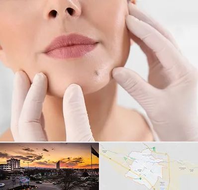 برداشتن خال در قوچان