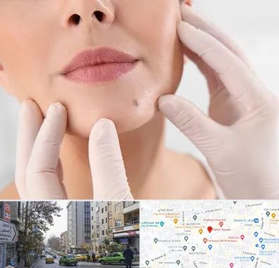 برداشتن خال در فاطمی