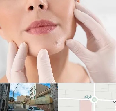 برداشتن خال در خزانه