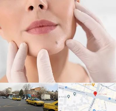 برداشتن خال در شهناز تبریز