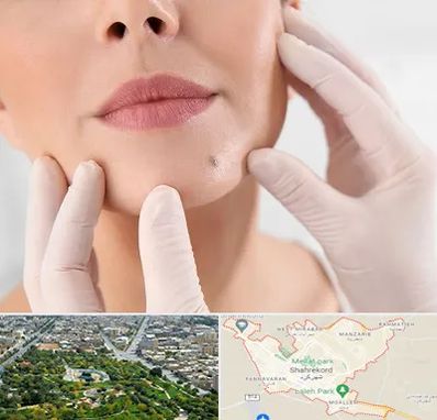 برداشتن خال در شهرکرد