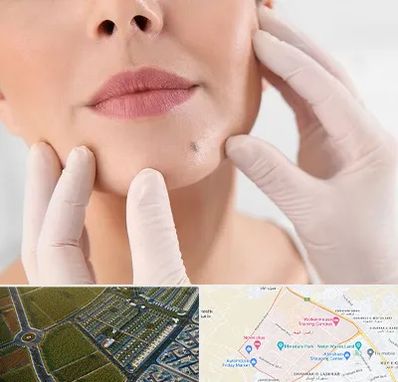 برداشتن خال در الهیه مشهد