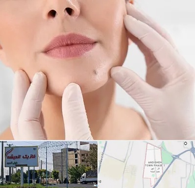 برداشتن خال در فاز یک اندیشه