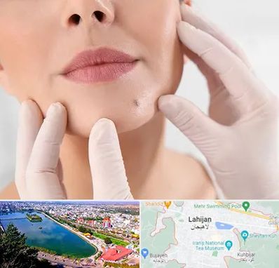 برداشتن خال در لاهیجان