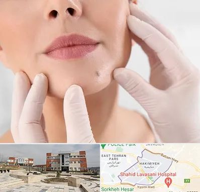 برداشتن خال در حکیمیه 