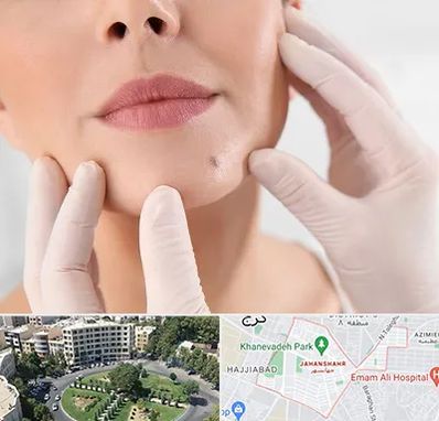 برداشتن خال در جهانشهر کرج 