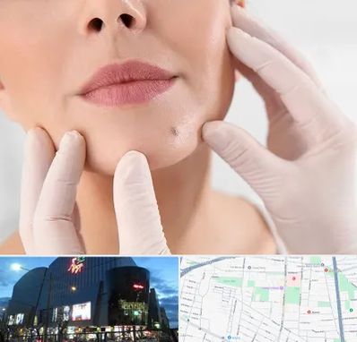 برداشتن خال در بلوار اباذر