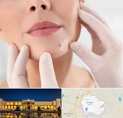 برداشتن خال در برازجان