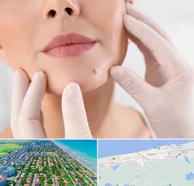 برداشتن خال در فریدونکنار