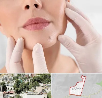برداشتن خال در جماران