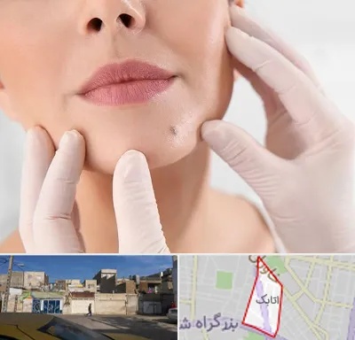برداشتن خال در اتابک