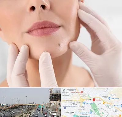 برداشتن خال در بلوار توس مشهد