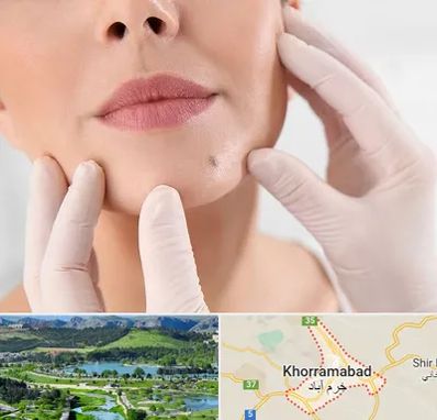 برداشتن خال در خرم آباد