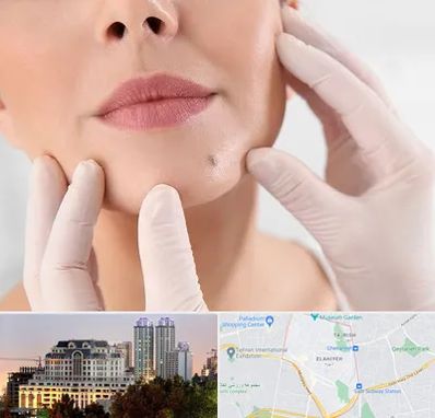 برداشتن خال در فرشته 