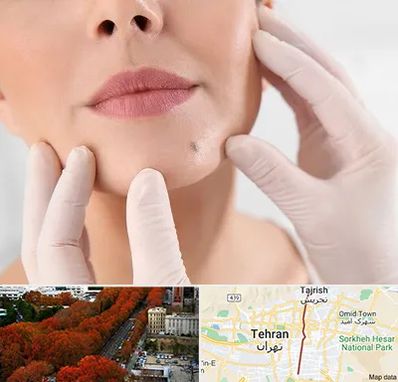 برداشتن خال در ولیعصر 