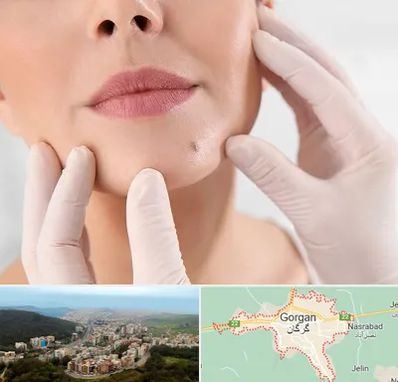 برداشتن خال در گرگان