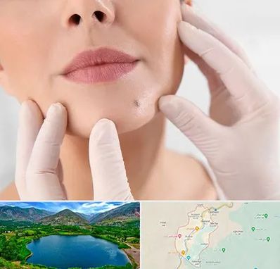 برداشتن خال در رودبار