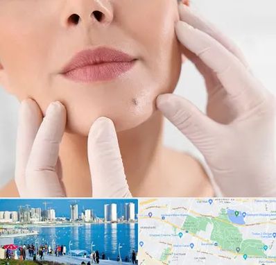 برداشتن خال در چیتگر 