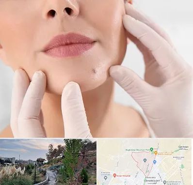 برداشتن خال در باغستان کرج