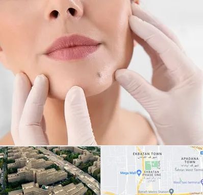 برداشتن خال در اکباتان 