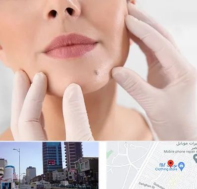 برداشتن خال در چهارراه طالقانی کرج