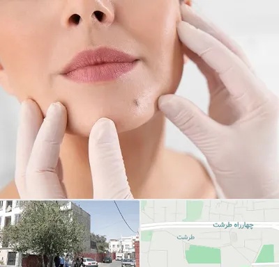 برداشتن خال در طرشت