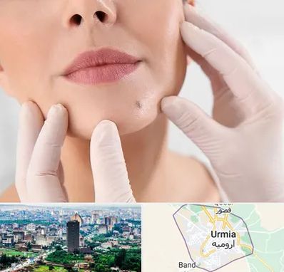 برداشتن خال در ارومیه