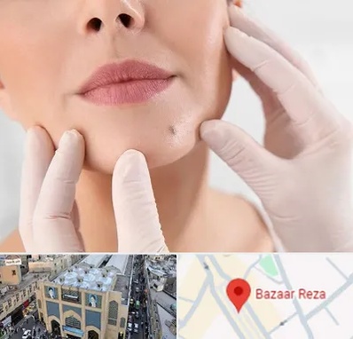 برداشتن خال در بازار رضا مشهد