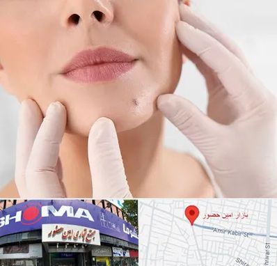 برداشتن خال در امین حضور