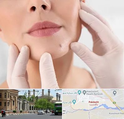 برداشتن خال در پاکدشت