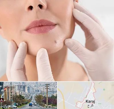 برداشتن خال در گوهردشت کرج 