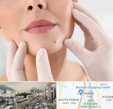 برداشتن خال در پونک 