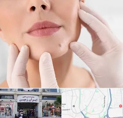 برداشتن خال در ایران زمین