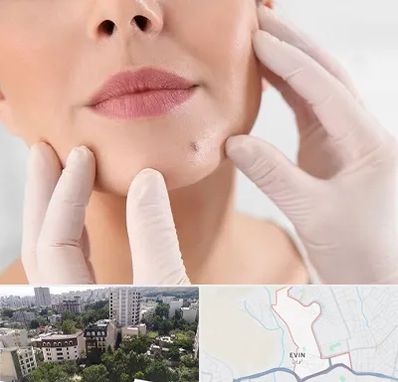 برداشتن خال در اوین