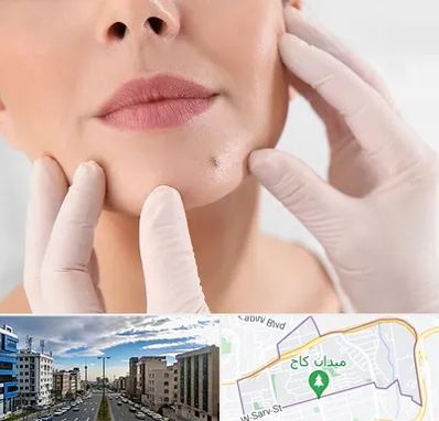 برداشتن خال در سعادت آباد 