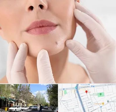 برداشتن خال در کوی فیروز تبریز