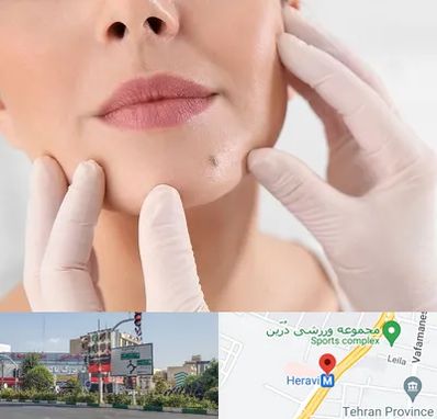 برداشتن خال در هروی 