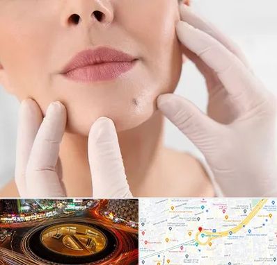 برداشتن خال در میدان ولیعصر