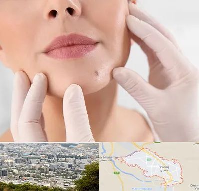 برداشتن خال در یاسوج