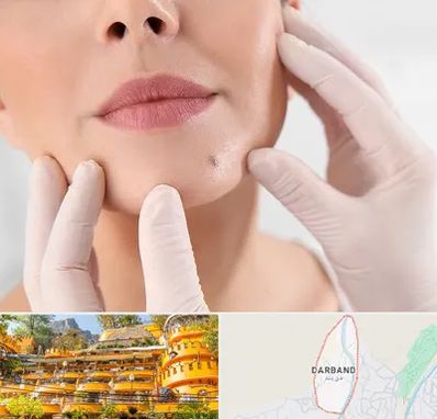 برداشتن خال در دربند