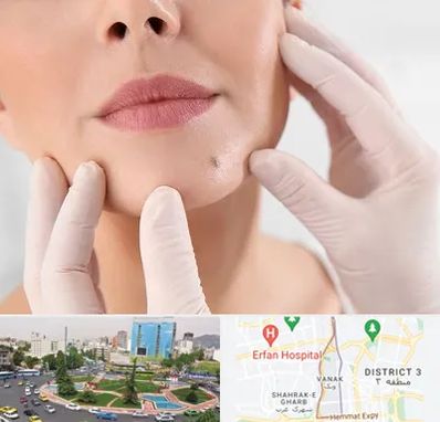 برداشتن خال در ونک 