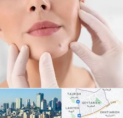 برداشتن خال در قیطریه 