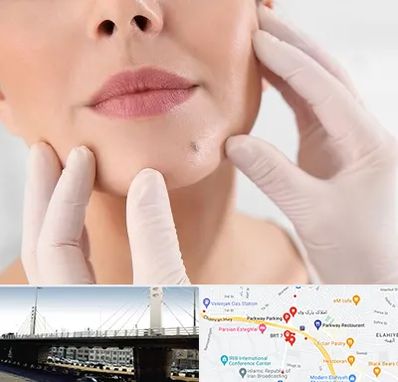 برداشتن خال در پارک وی 