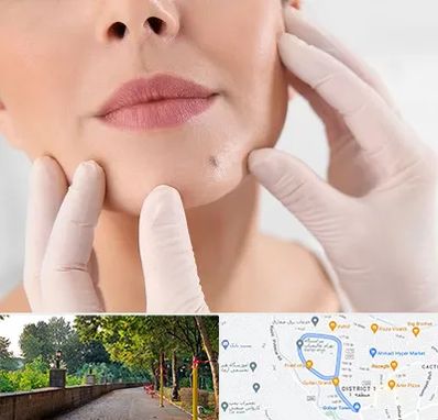 برداشتن خال در بلوار گیلان رشت