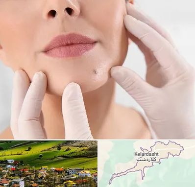 برداشتن خال در کلاردشت