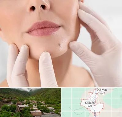 برداشتن خال در کلاله