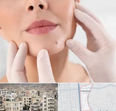 برداشتن خال در اسکندری