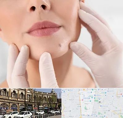 برداشتن خال در منطقه 11 تهران