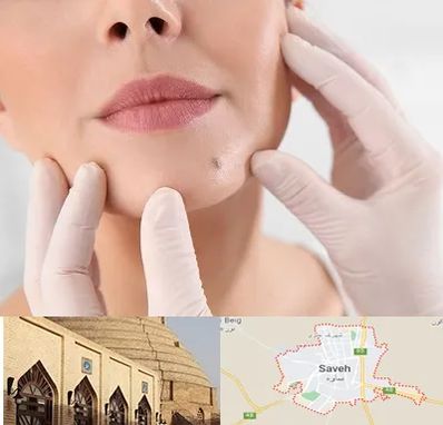 برداشتن خال در ساوه